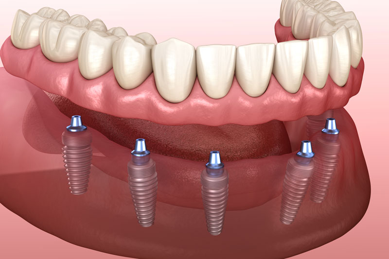 denture supported implants with 6 abunments placed onto the jaw