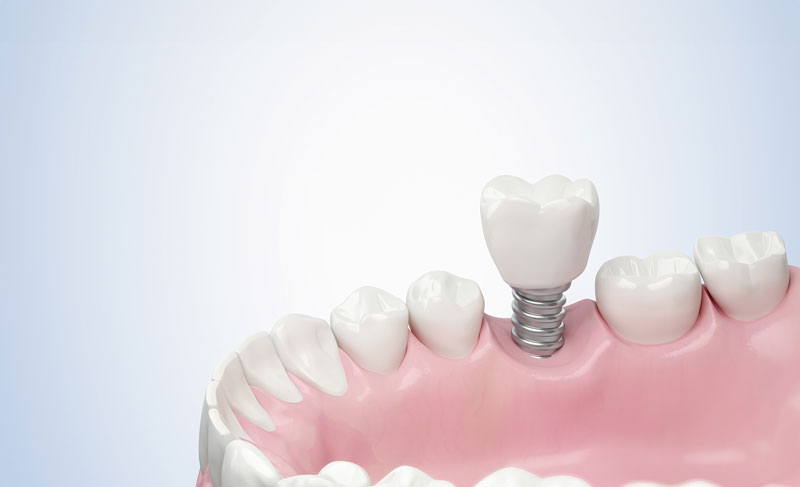 Discover the benefits of dental implants as a complete teeth replacement option. Learn why they're an effective choice at Renew Dental Implant Center.