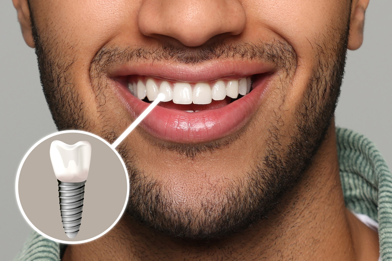 Unveiling the Secrets: What Are Dental Implants Made Of?